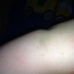 eczema1