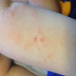 eczema2