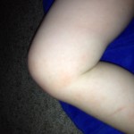 eczema3