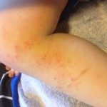 eczema4